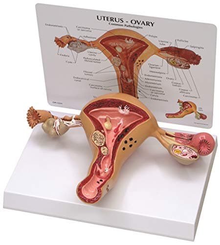 Uterus Ovary Anatomical Model With Pathologies/Key Card