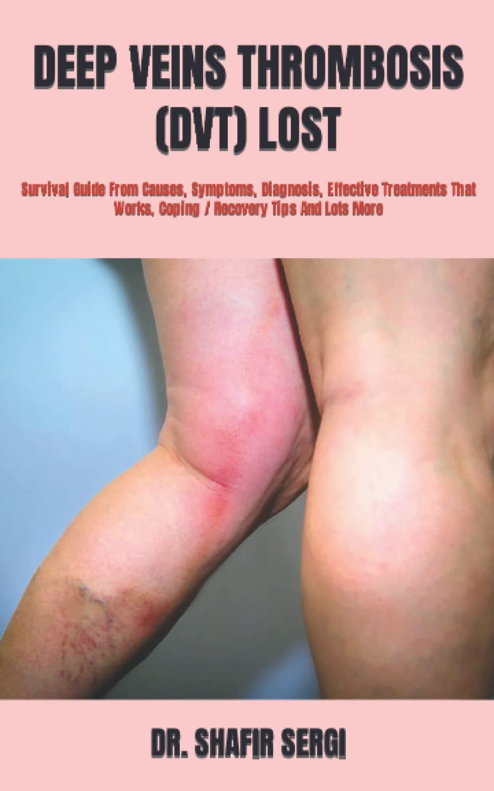 DEEP VEINS THROMBOSIS (DVT) LOST: Survival Guide From Causes, Symptoms, Diagnosis, Effective Treatments That Works, Coping / Recovery Tips And Lots More