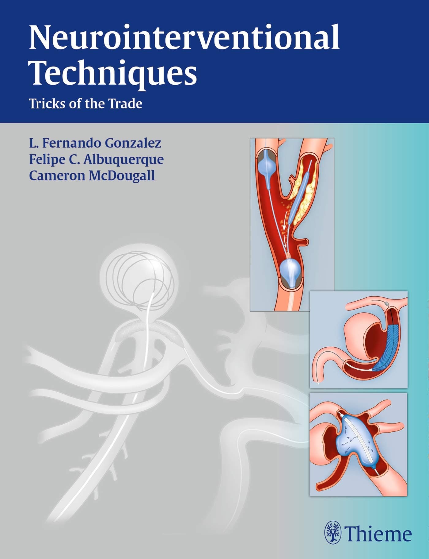 Neurointerventional Techniques: Tricks of the Trade 1st Edition